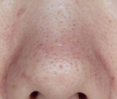 3/22・２週間後の鼻の写真