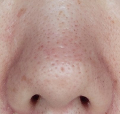 3/22・２週間後の鼻の写真