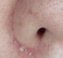 ２週間後の白ニキビの写真