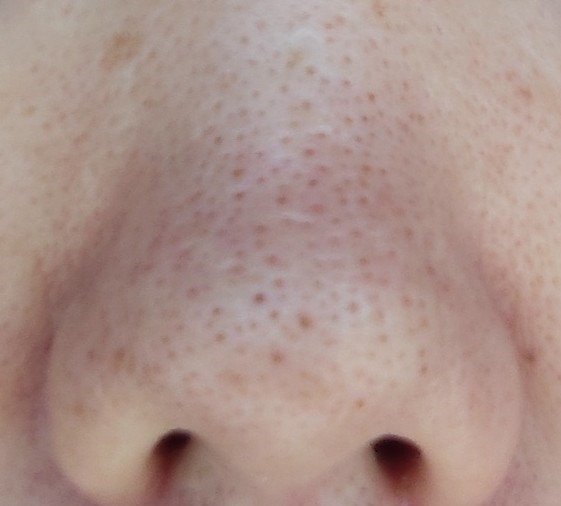 3/8頃の鼻の写真