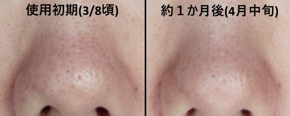 デメランクリーム使用前と約1か月後の鼻の毛穴・黒ずみ比較画像（3月初旬と4月中旬）