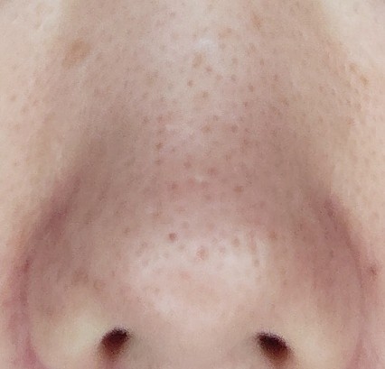 デメランクリーム使用1か月後の鼻の写真（毛穴の状態）