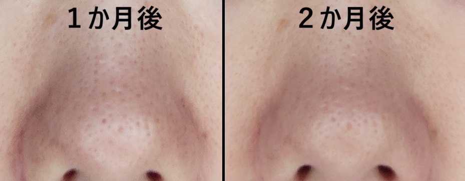 デメランクリーム使用1ヶ月後と2ヶ月後の鼻の肌状態比較