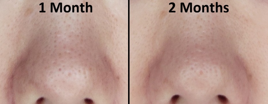 Comparison of nose skin after 1 month and 2 months of using Demelan Cream