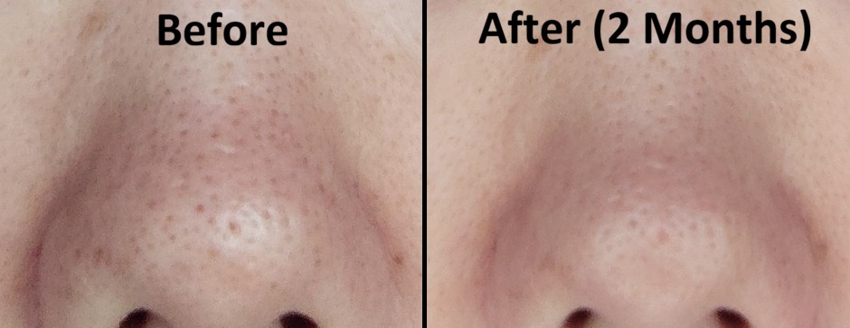 Before and after comparison of nose skin after 2 months use of Demelan Cream