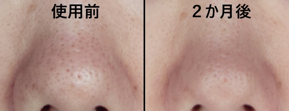 インドのスキンケアクリームDemelan Cream使用前と2ヶ月後の鼻の比較写真